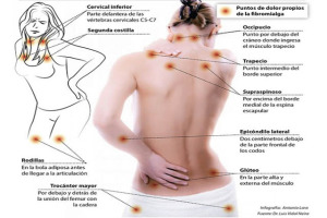 Fibromialgia-2